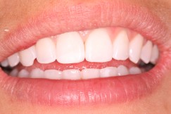 Case studies - Chipped Front Tooth After