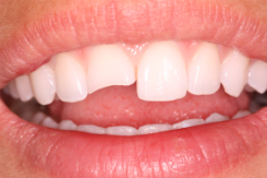 case studies - Chipped Front Tooth Before