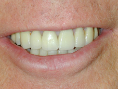 case study - Cosmetic Restoration Case 2 After