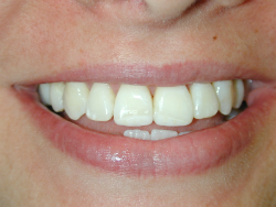 Eroded Front Teeth After