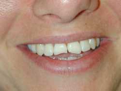 case study - Eroded Front Teeth Before