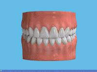 beechwood dental crowns