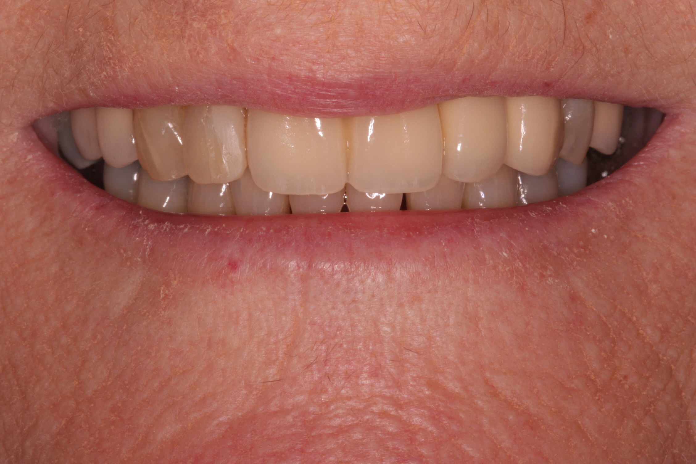implant case study 1 after picture
