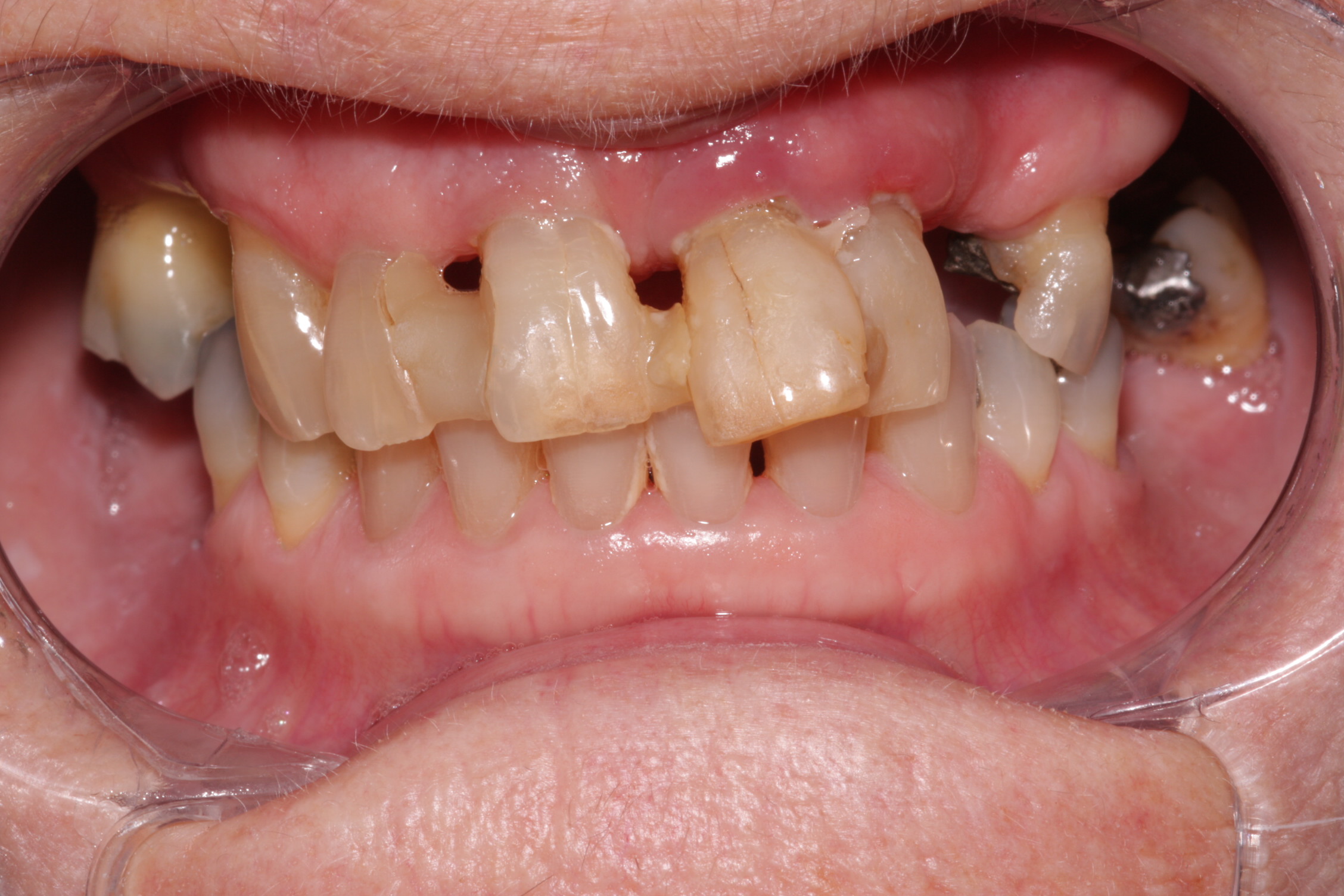 Implant case study 1 before picture
