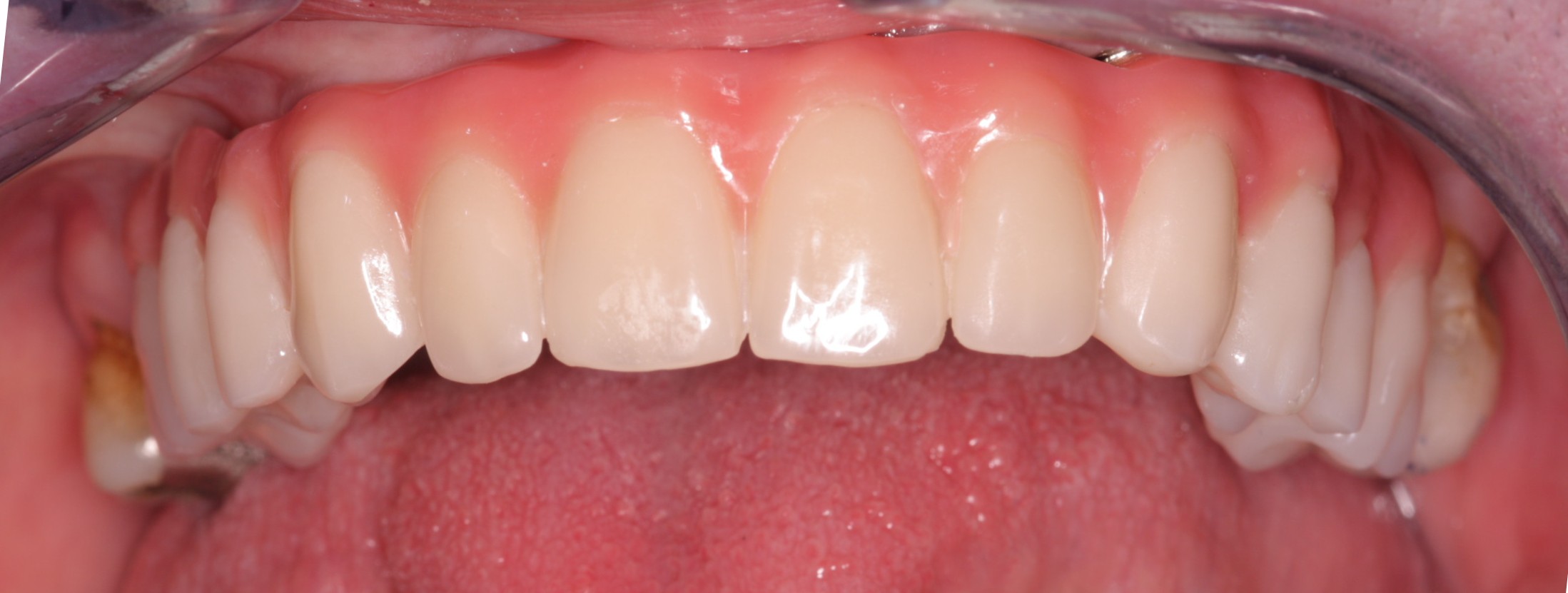 implant case study 4 after picture