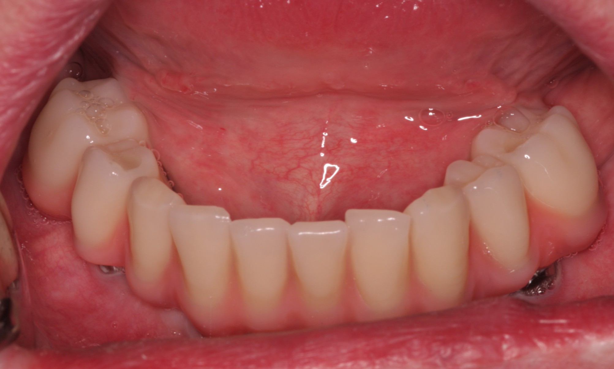 implant case study 2 after picture