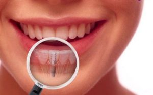 Transparent image of a dental implant in the mouth