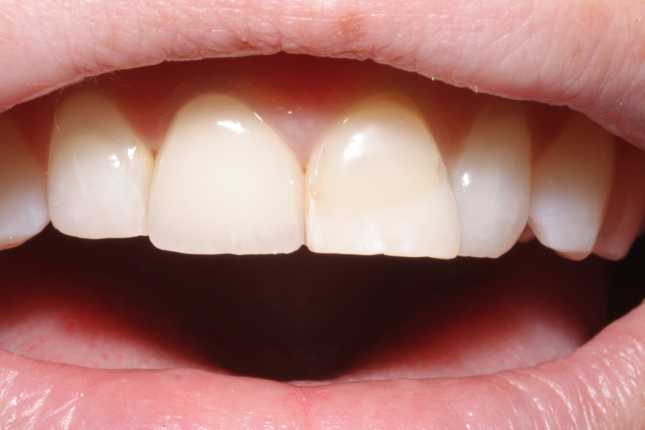 case study - beechwood dental_missing front tooth_after