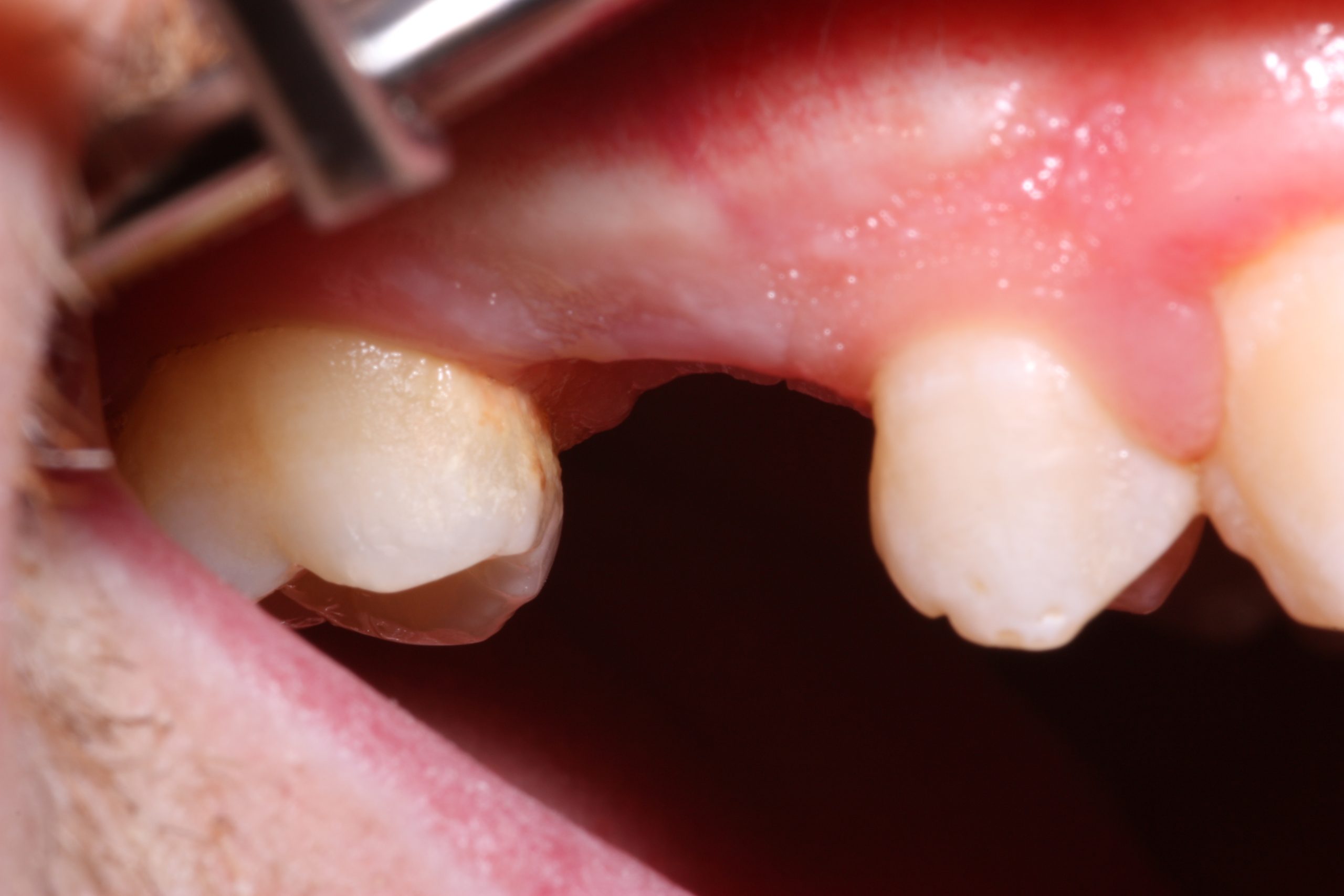 case study - B1 Missing pre molar case study_beechwood dental