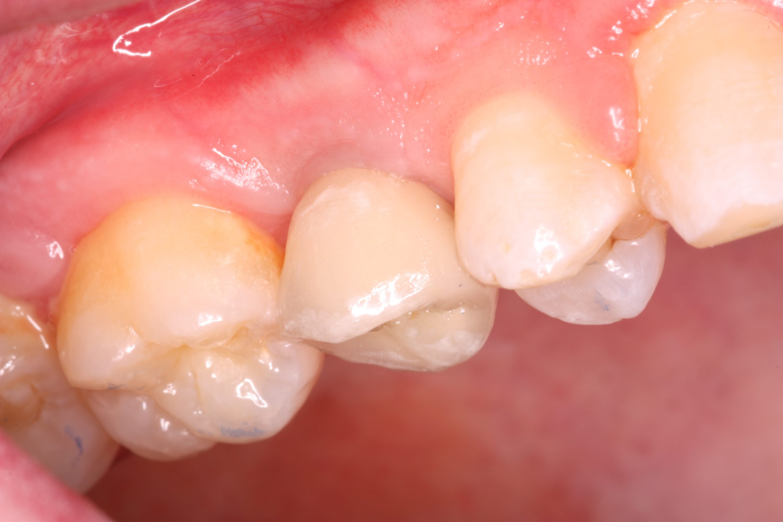 case study - B2 Missing pre molar after_beechwood dental