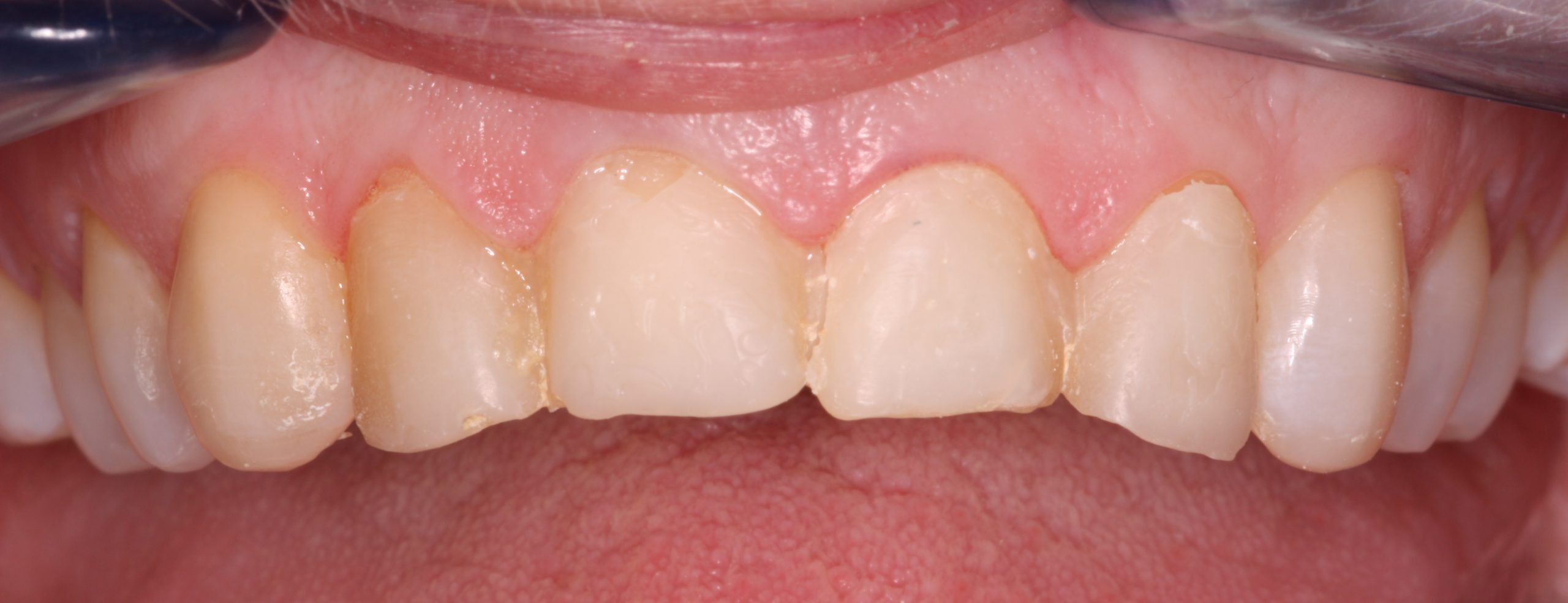 veneers - before picture of a patient before undergoing veneers treatment _beechwood dental_best dentist dublin