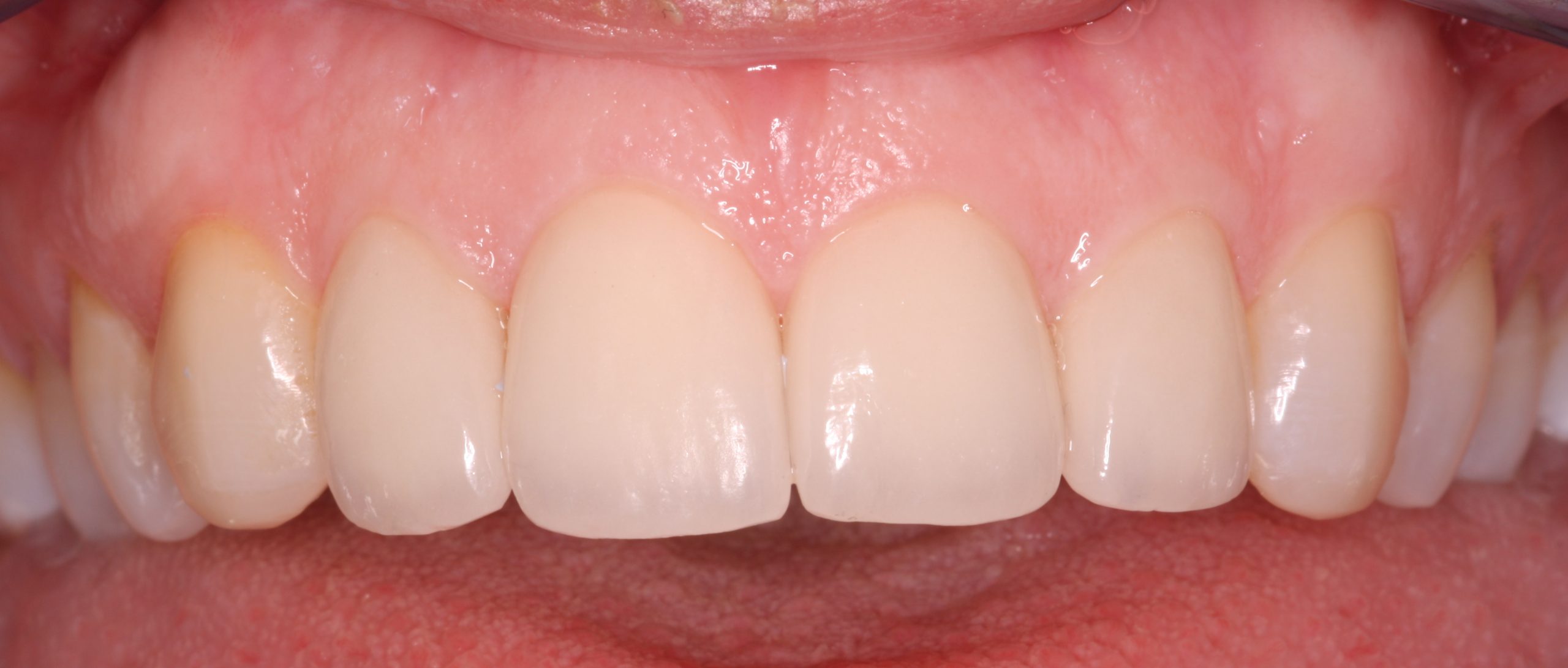 veneers - After picture of a patient after undergoing veneers treatment N2N1_beechwood dental_best dentist dublin