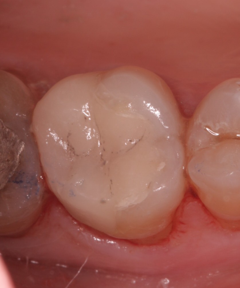 S2 Beechwood Dental_best dentist dublin 6 white dental filling