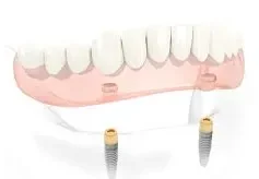 all-on-four dental implants, supporting full dental bridge.