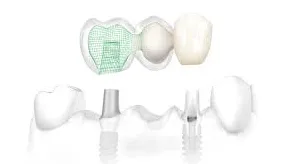 Bridge Supported Dental implant illustration
